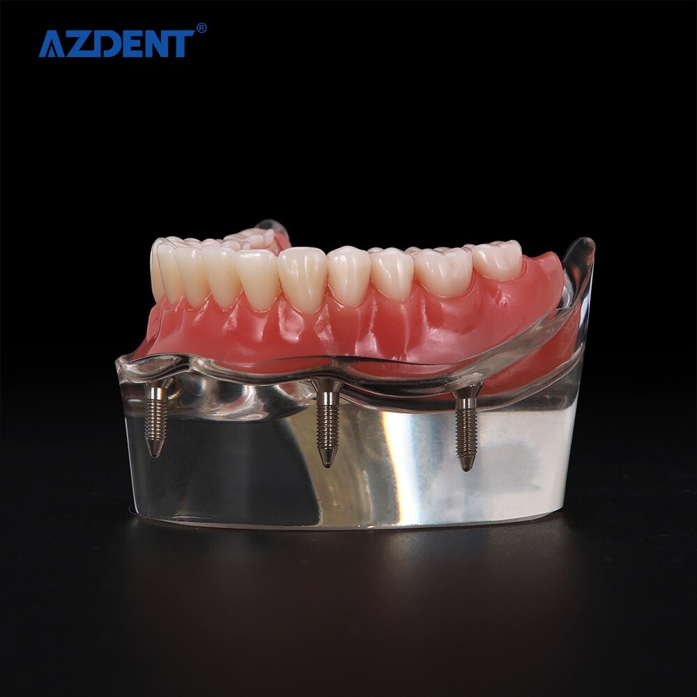 Dental Demonstration 4 Implants Teeth Model Typodont Inferior Overdenture Lower