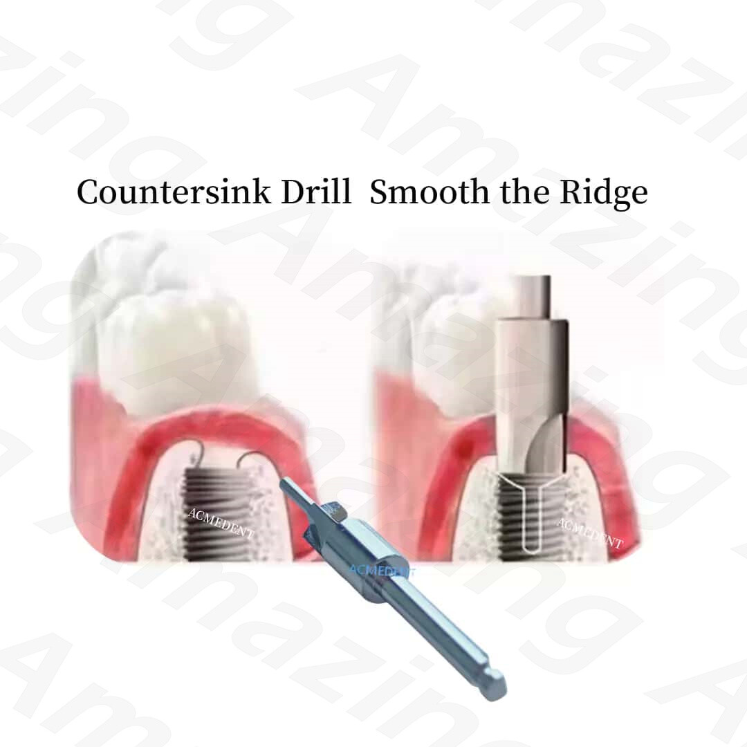 5.2MM Dental Countersink Drill Profiler Remover Smooth Ridge Trimmer Drills