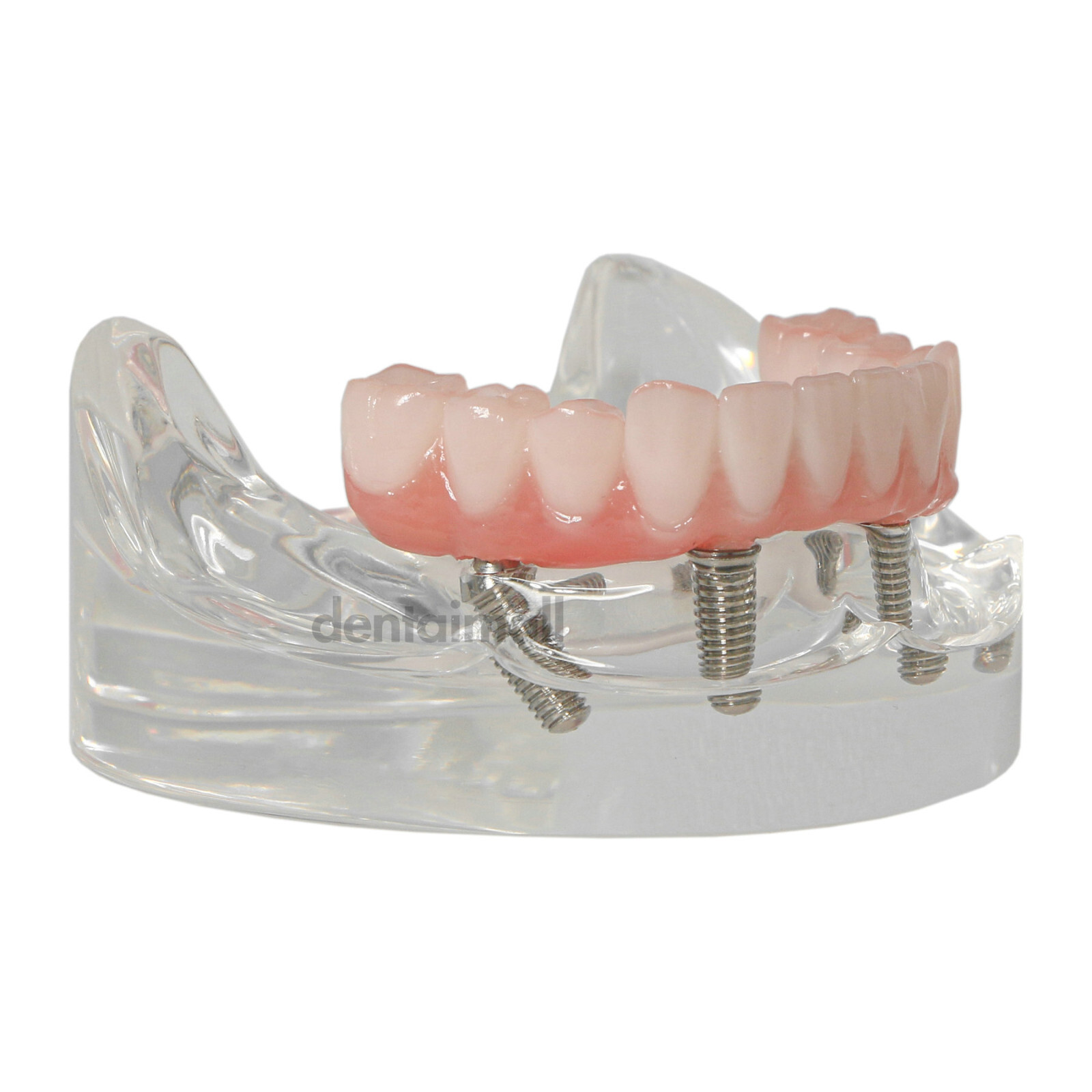 US Dental 4 Screws Overdenture Model All on 4 Restoration Upper/Lower Jaw Type