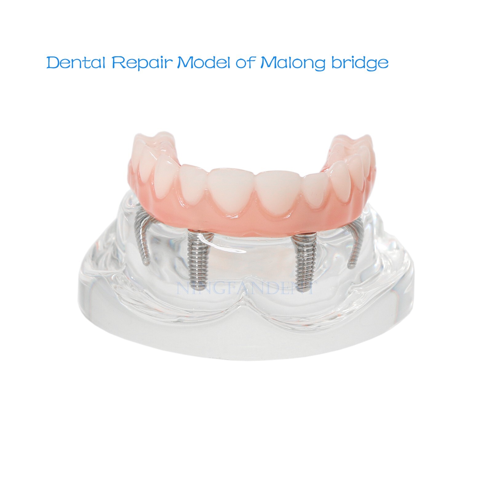 USAll on 4 Dental Implant Model Overdenture Upper Jaw 4 Implant Clear Detachable