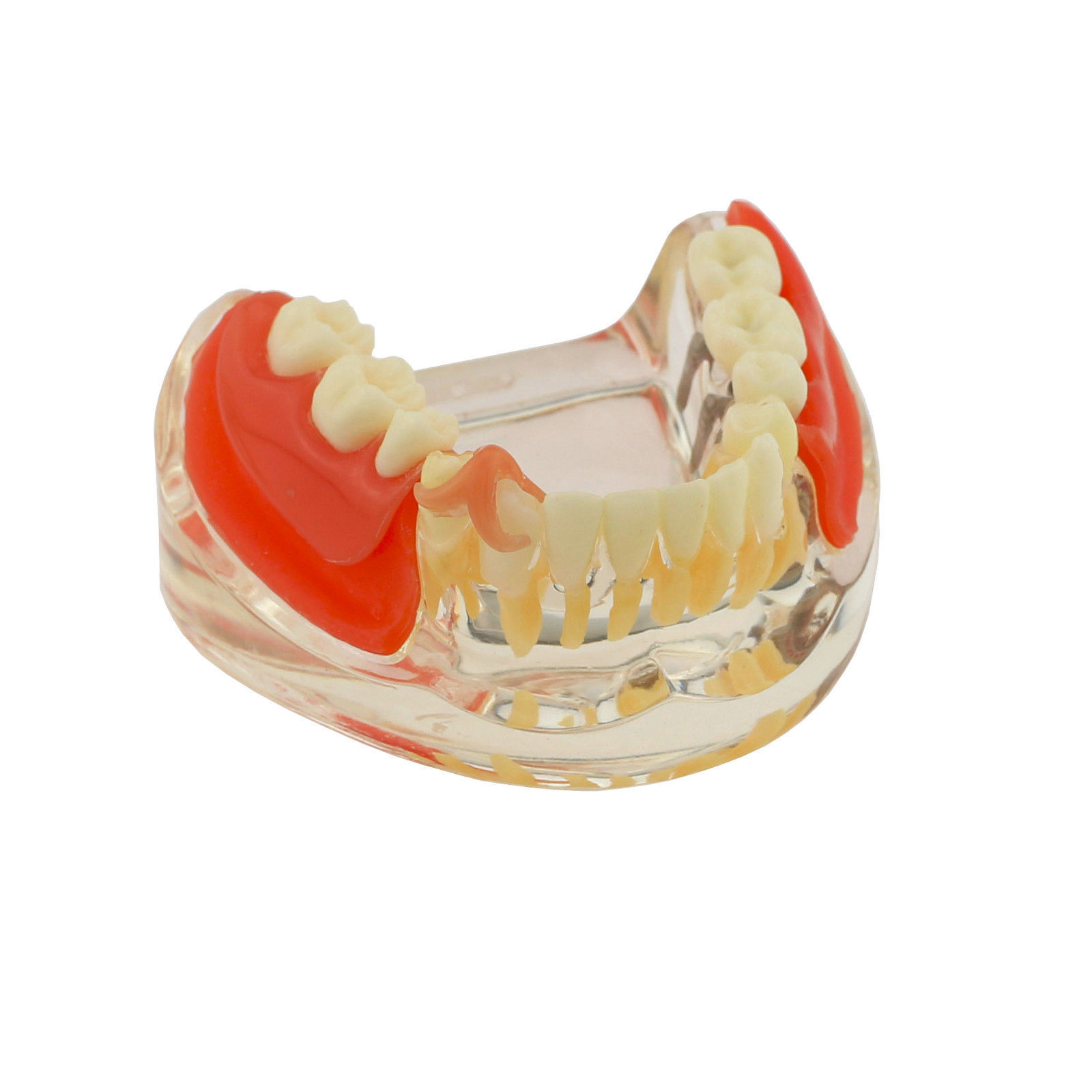 Dental Implants Restoration Model Overdenture Inferior With Demo Teaching Study