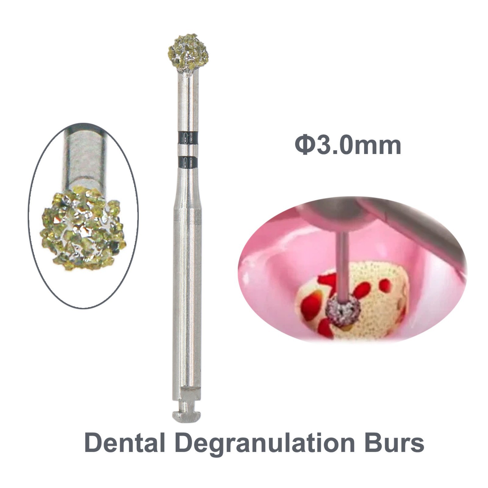 4Pcs/Kit Degranulation Burs Kit Osseous Debridement Remove Bone Tissue Remnant