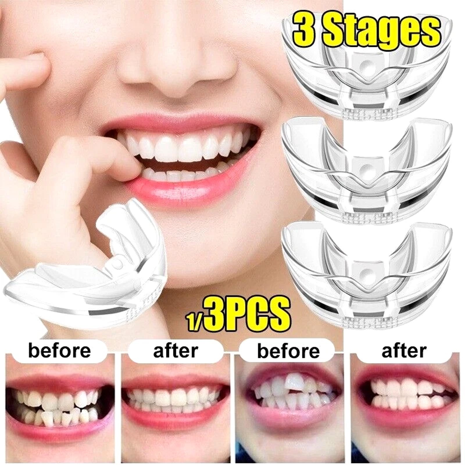 Dental Multifunctional Invisible Braces Orthodontic Smile Teeth Alignment Traine
