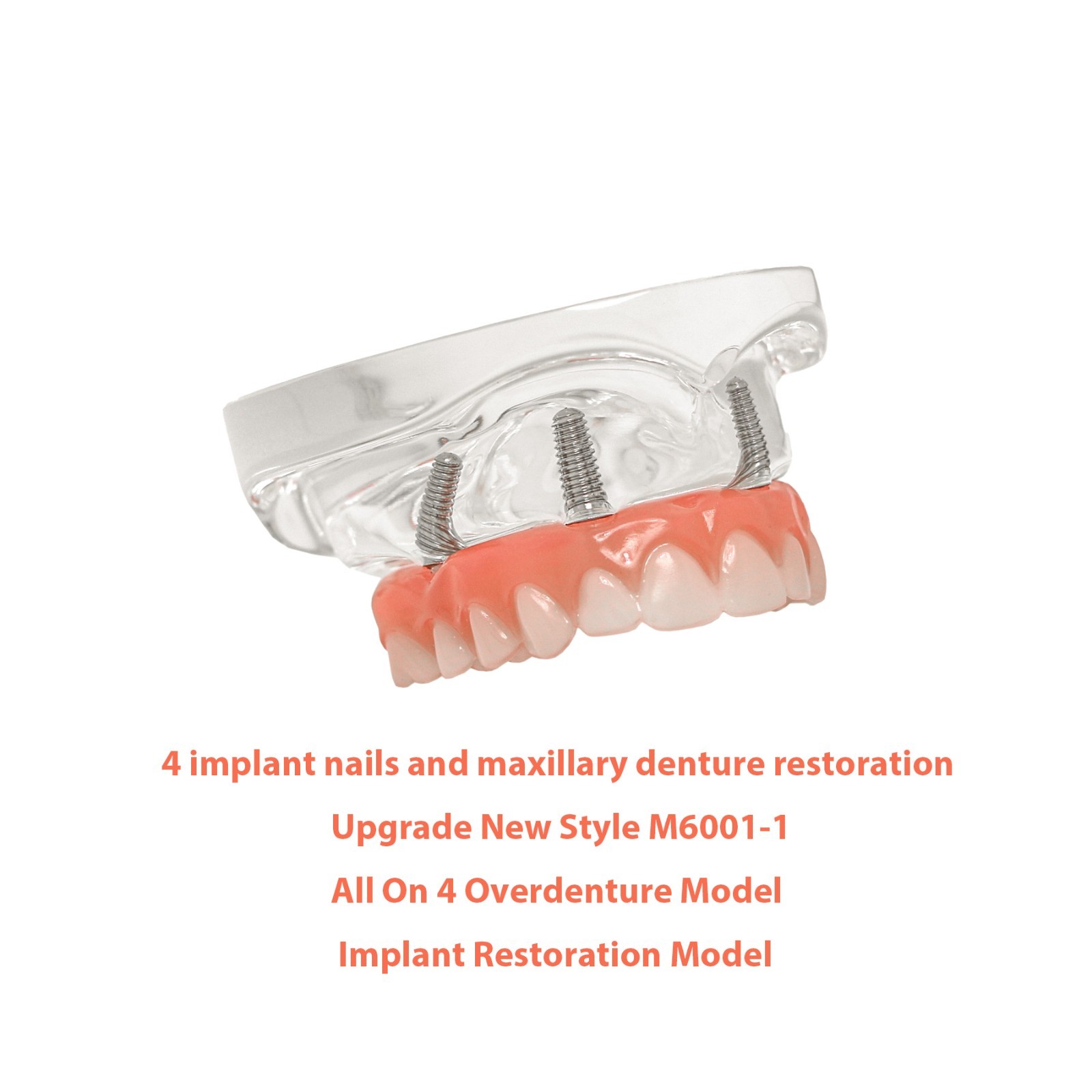 US Dental Implant Restoration Model All-on-4 All-on-6 Upper/Low Jaw Demo