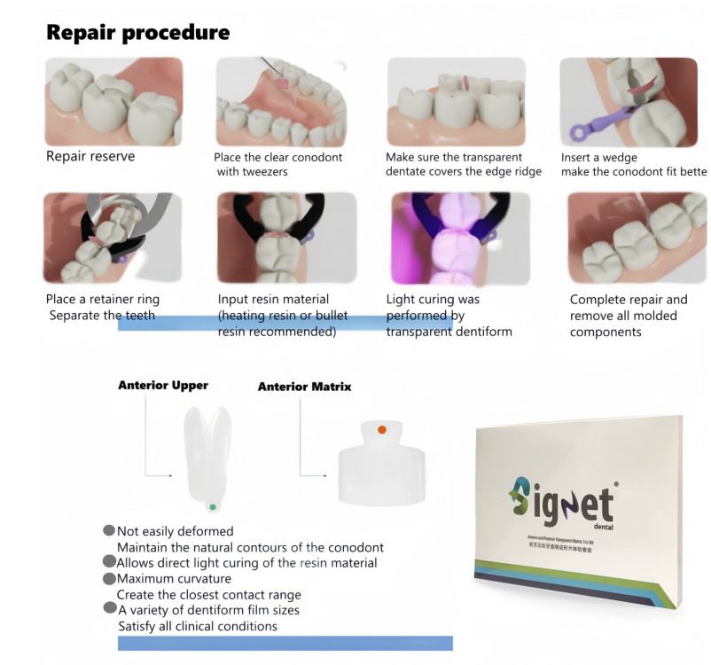 Dental Transparent Matrix Bands Clear Matrices Anterior Molar Bow Front Bioclear