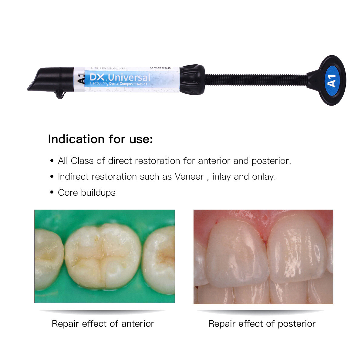 Dentex Dental Universal Composite Light Cure Resin A1/A2/A3/A3.5/B1/B2 Shade
