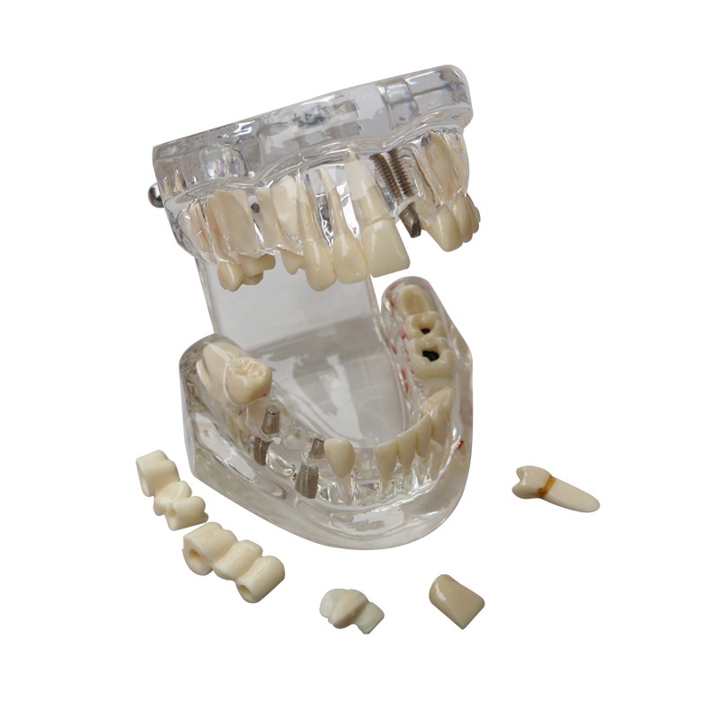 Dental Teeth Model Ortho Implant Practice Teaching With Implants Demo Model