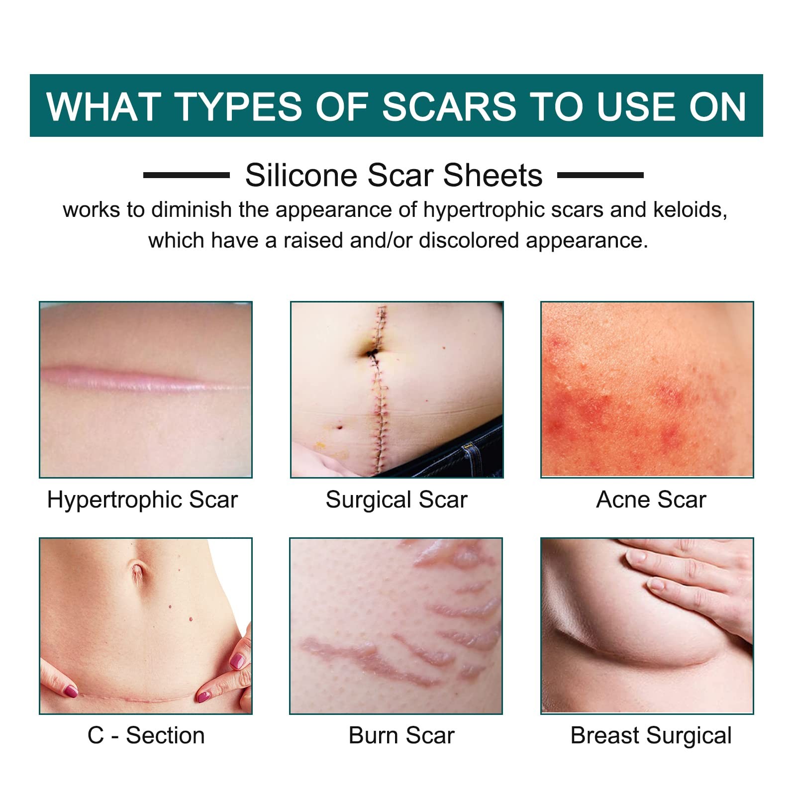 Silicone Scar Sheets (1.6” x 120” Roll-3M), 120×1.6 Inch (Pack of 1), Brown