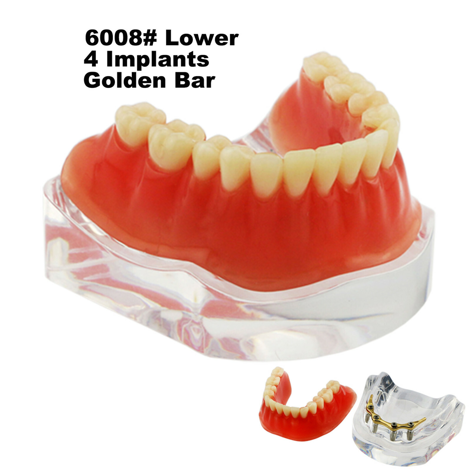 Dental Teeth Model 2 4 Implant Overdenture Typodont Restoration Demo Upper Lower