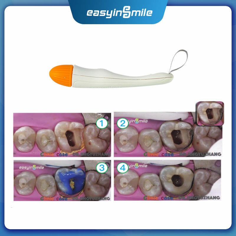 Dental Disposable Pro Matrix System Pre Formed Matrix Bands 50pcs 4.5/6.0mm