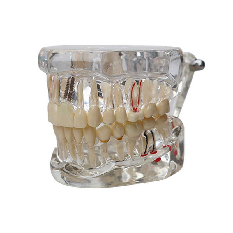 Dental Teeth Model Ortho Implant Practice Teaching With Implants Demo Model