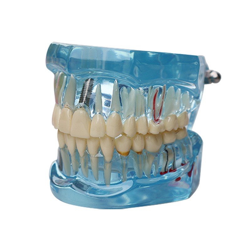 Dental Teeth Model Ortho Implant Practice Teaching With Implants Demo Model