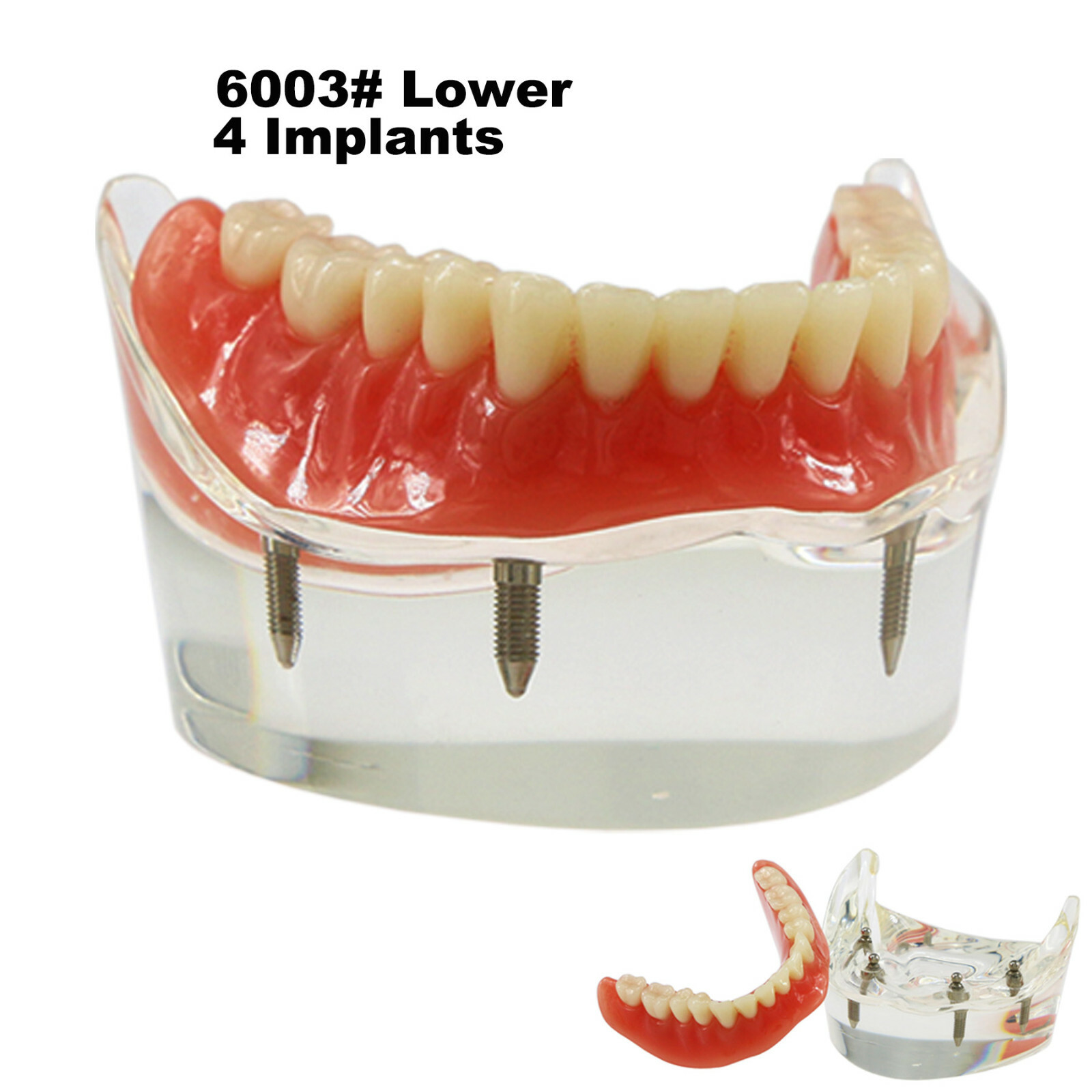 Dental Teeth Model 2 4 Implant Overdenture Typodont Restoration Demo Upper Lower