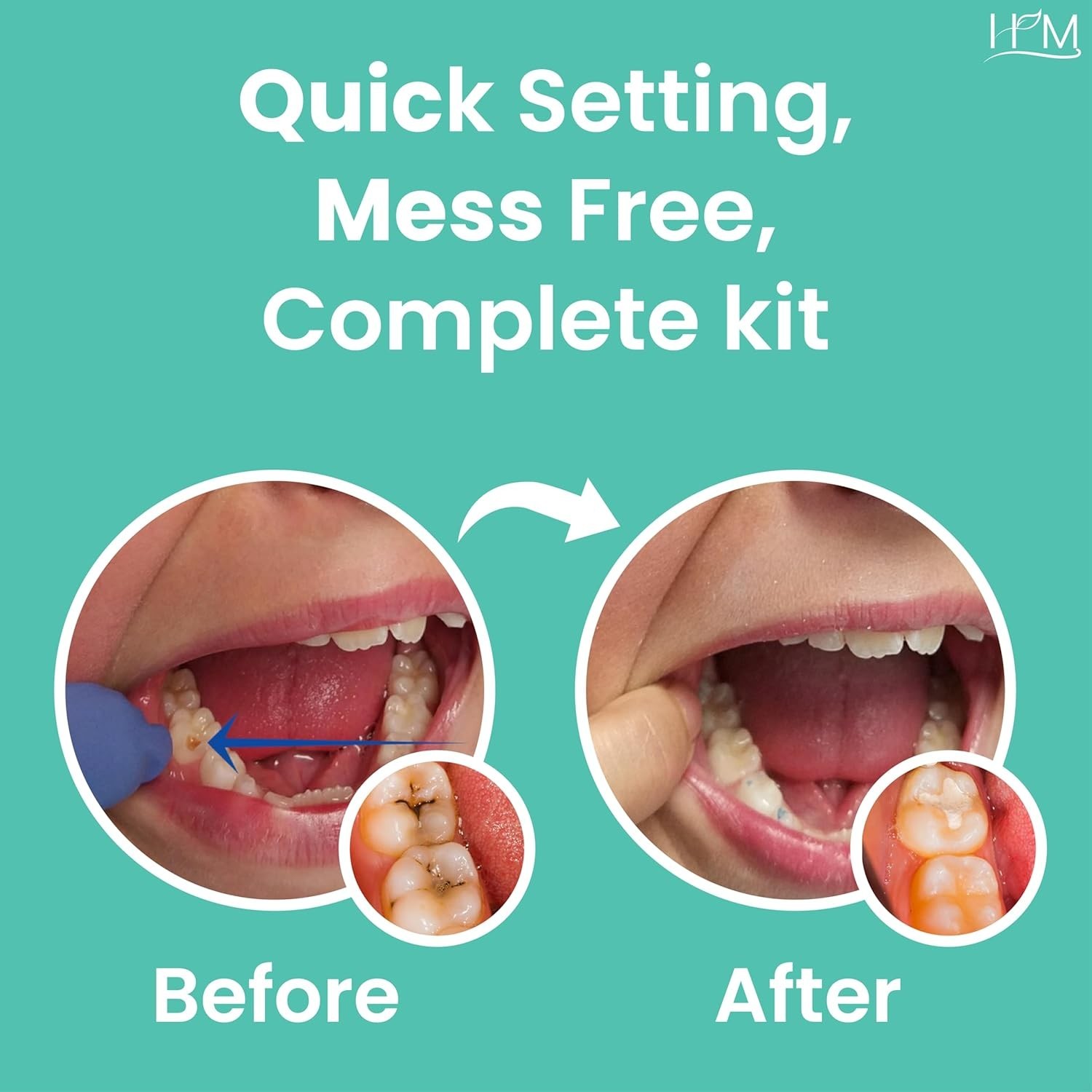 HM Zinc Oxide Eugenol Dental Cement Kit | Super Adhesive | Instant Tooth Repa…