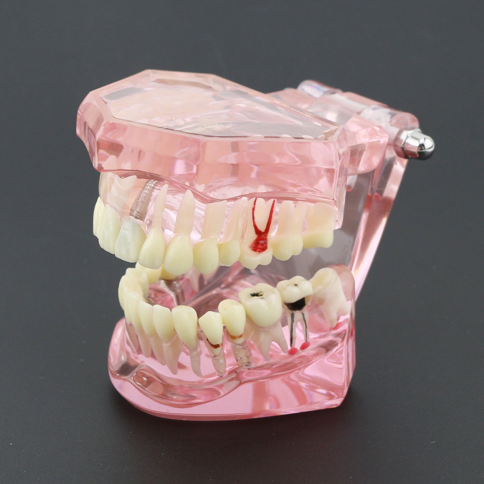 Dental Implant Teeth Model Teach Study Demo Restoration Pathology #2001 Pink
