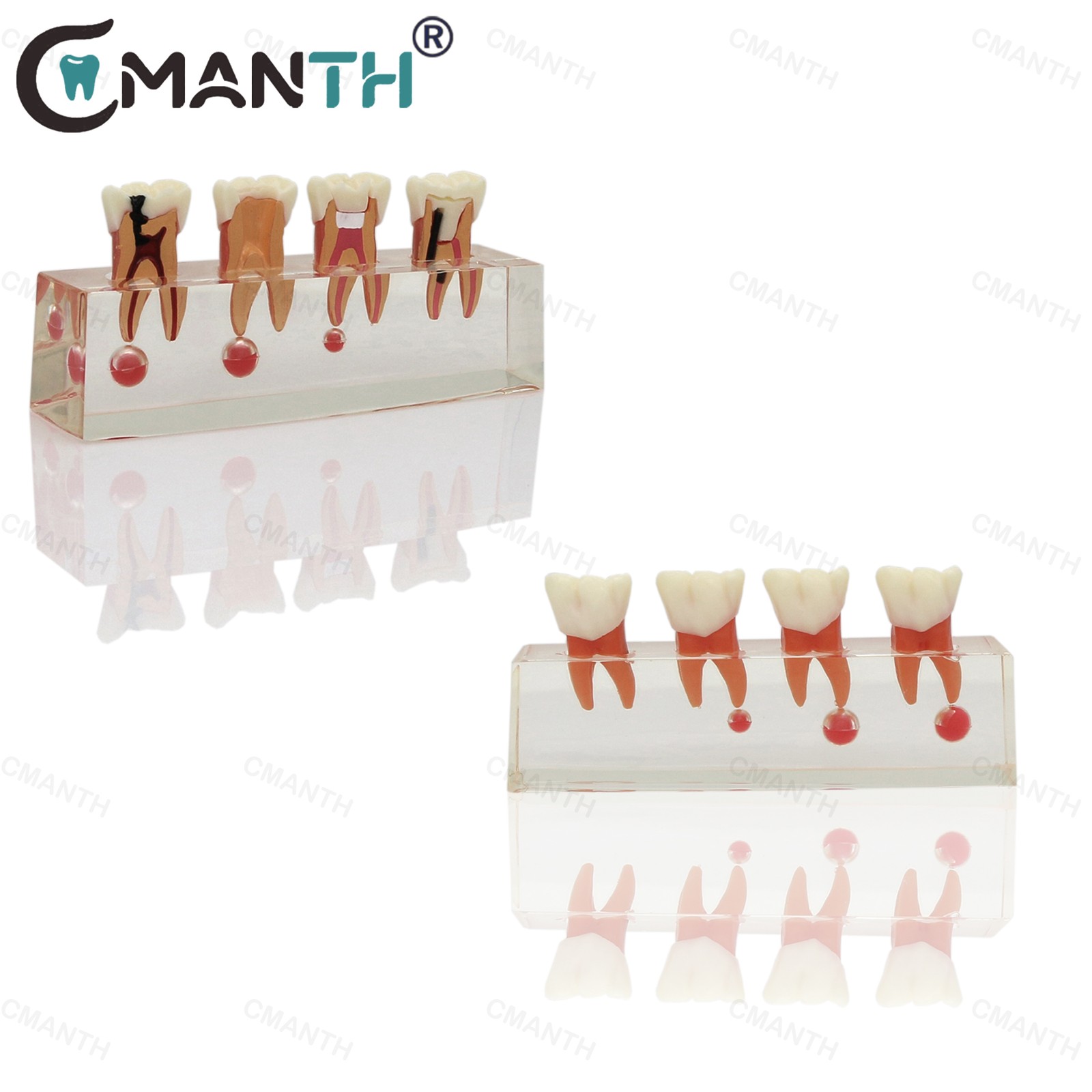 US Dental Teeth Model 4-Stage Molar Root Canal Caries Endodontic Treatment Study