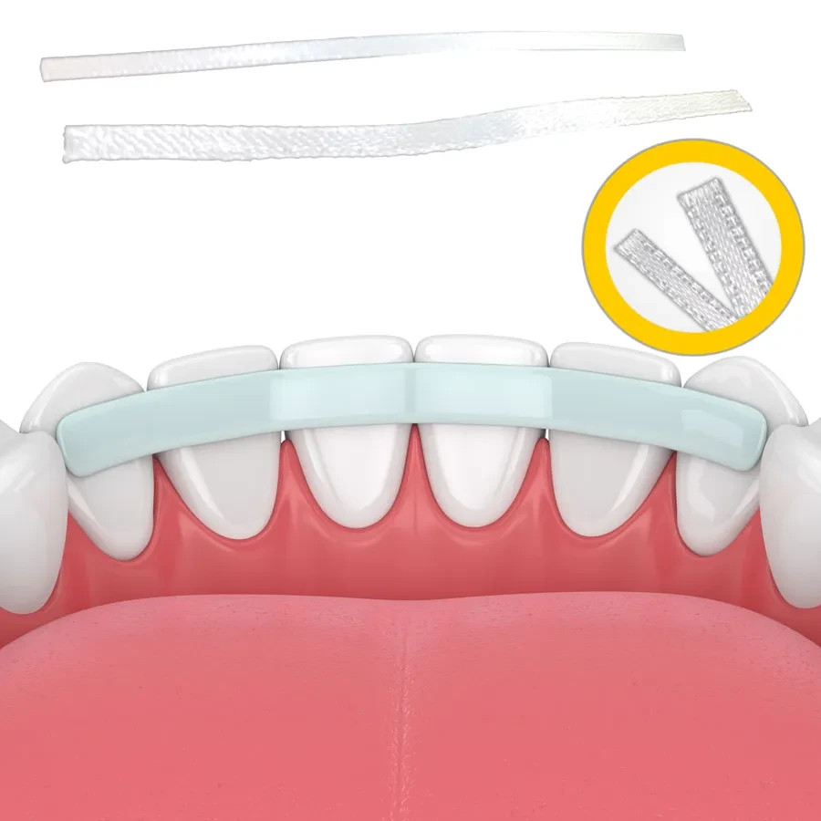Kids-e-Dental E-Splint Esthetic fiber-reinforced splint Asorted Free Shipping