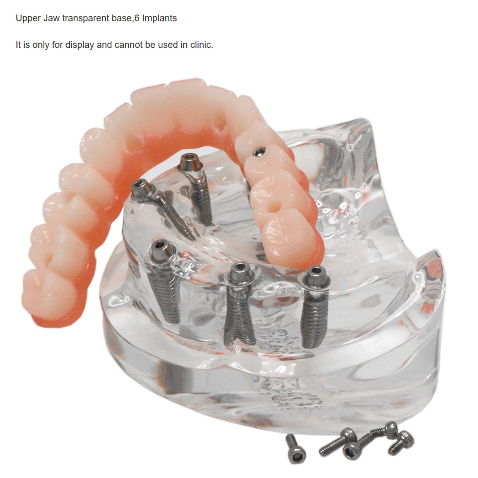US Dental Implant Teeth Model Overdenture All on 4/All on 6 treatment Demo Model