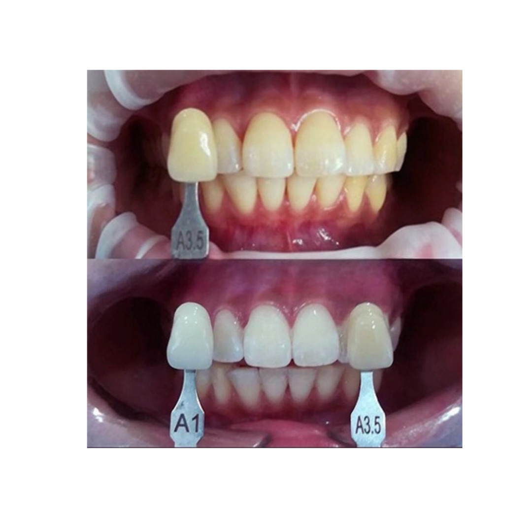 4 Color Dental Bleached Shade Guide Bleach Chart Teeth Whitening Based Vita