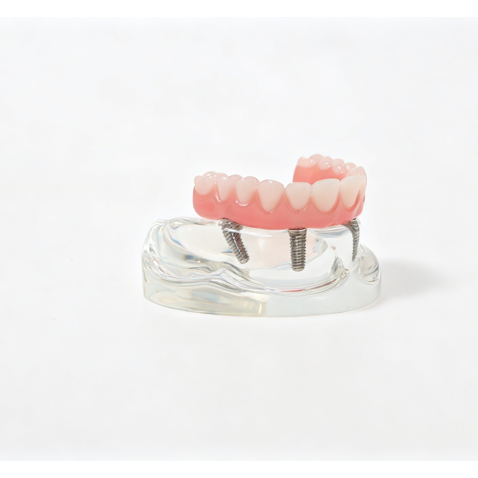 USAll on 4 Dental Implant Model Overdenture Upper Jaw 4 Implant Clear Detachable