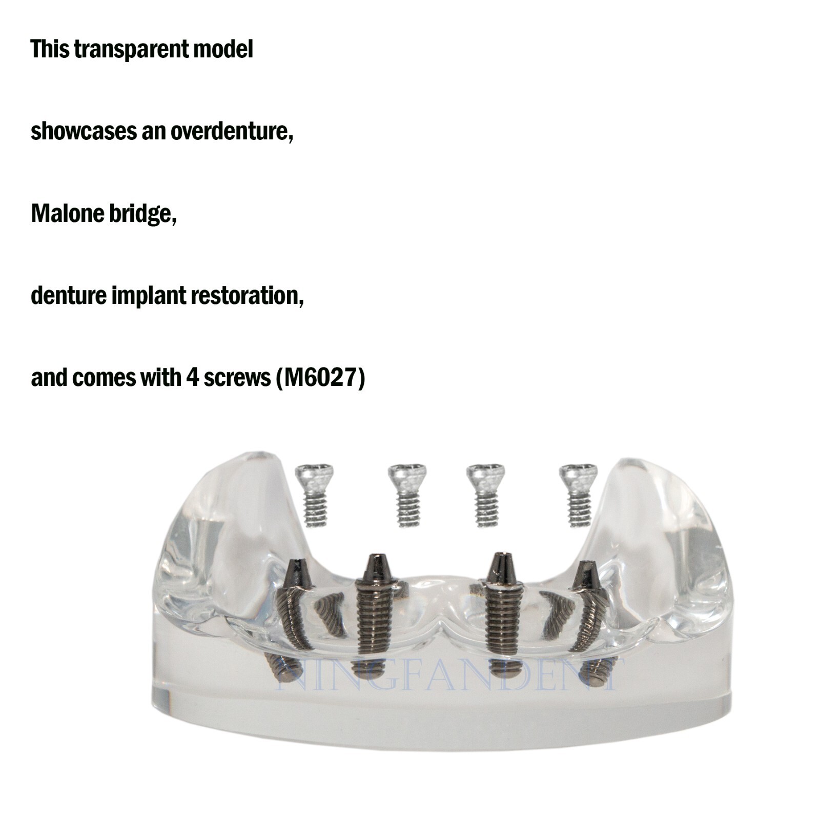 Dental All-on-4 Overdenture Implant Model, Upper/Lower Jaw-Clear,With 4 Screw