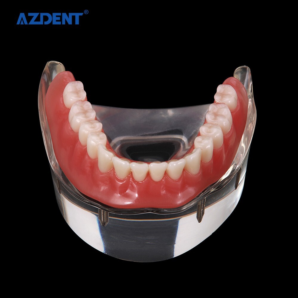 Dental Demonstration 4 Implants Teeth Model Typodont Inferior Overdenture Lower