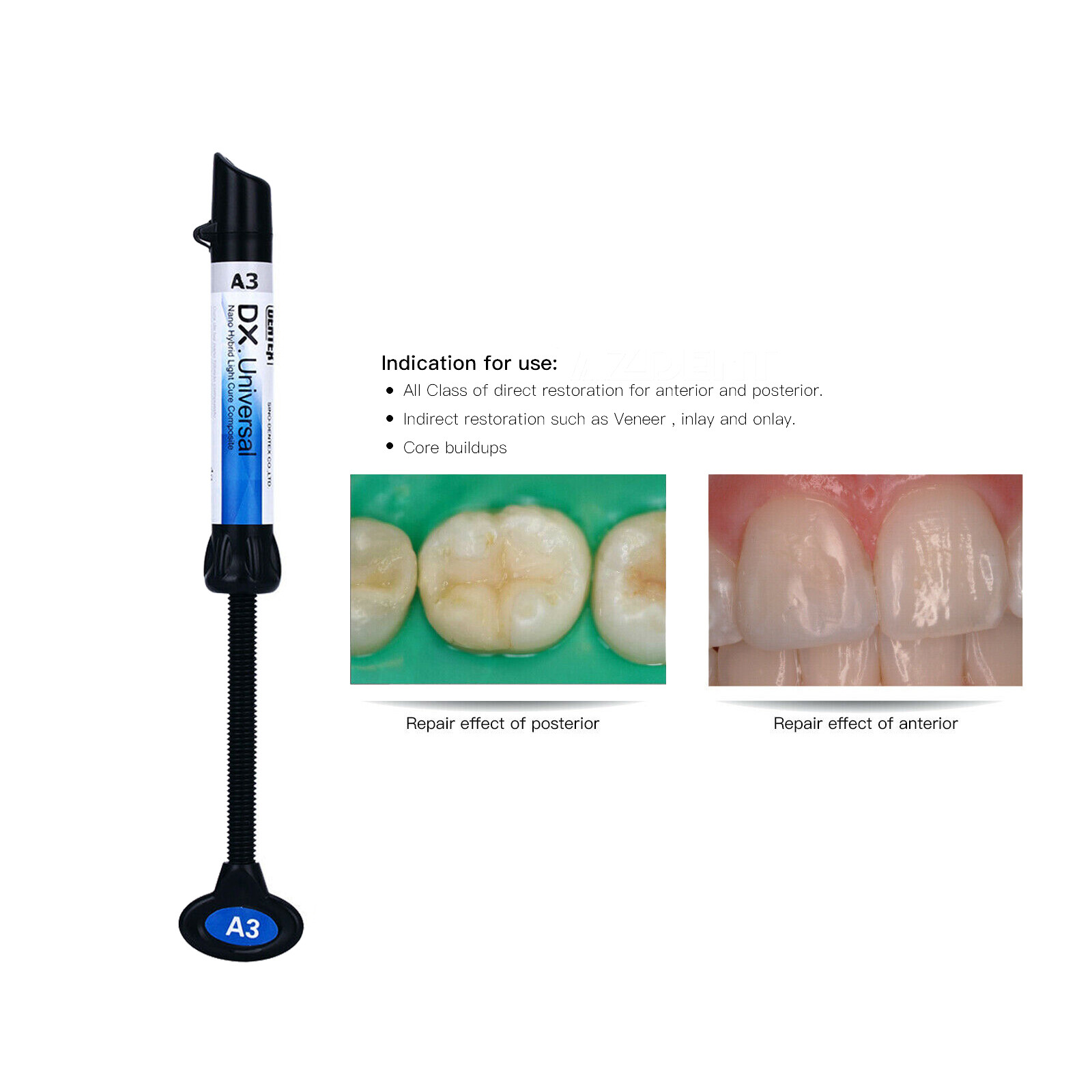 DX Dental Universal Light Cure Composite Resin A1,A2,A3,A3.5,B1 Shade 4g/Syringe