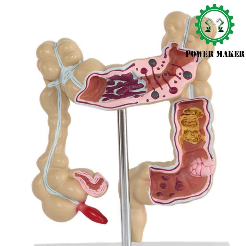 Colorectal Lesion Model Human Colon Large Intestine Pathological Diseases Model