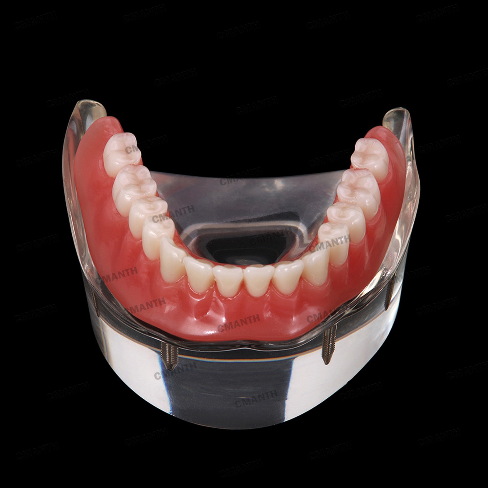 US Dental Model Removable Overdenture Teeth Upper/Lower Jaw 4 Implants Model