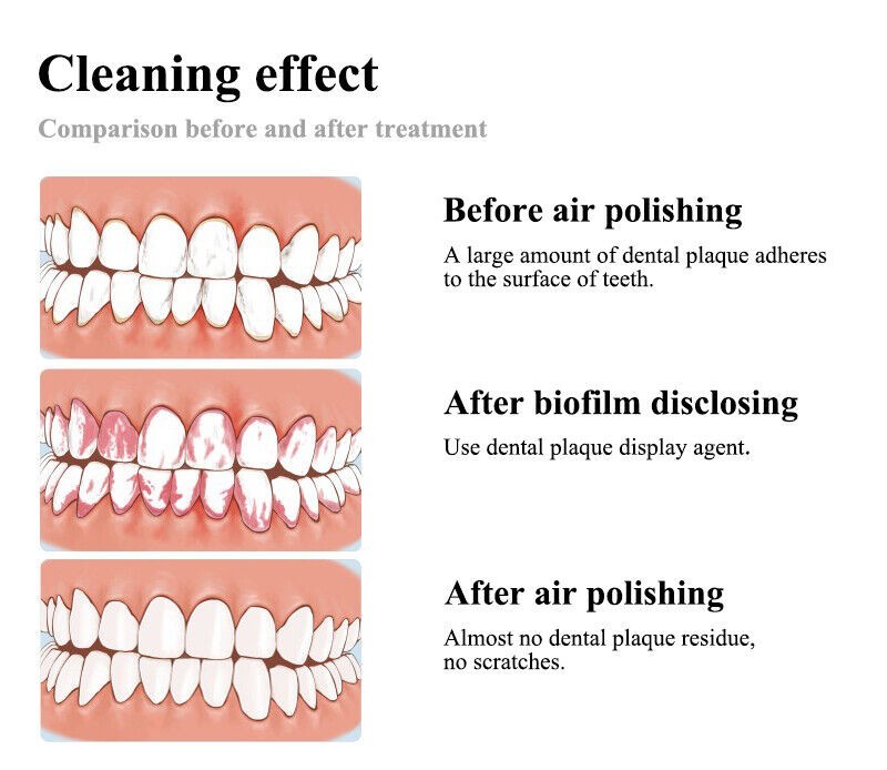 Teeth Whitening Spray Air Water Polisher Air Polish Handle Bicarbonate Jet Air