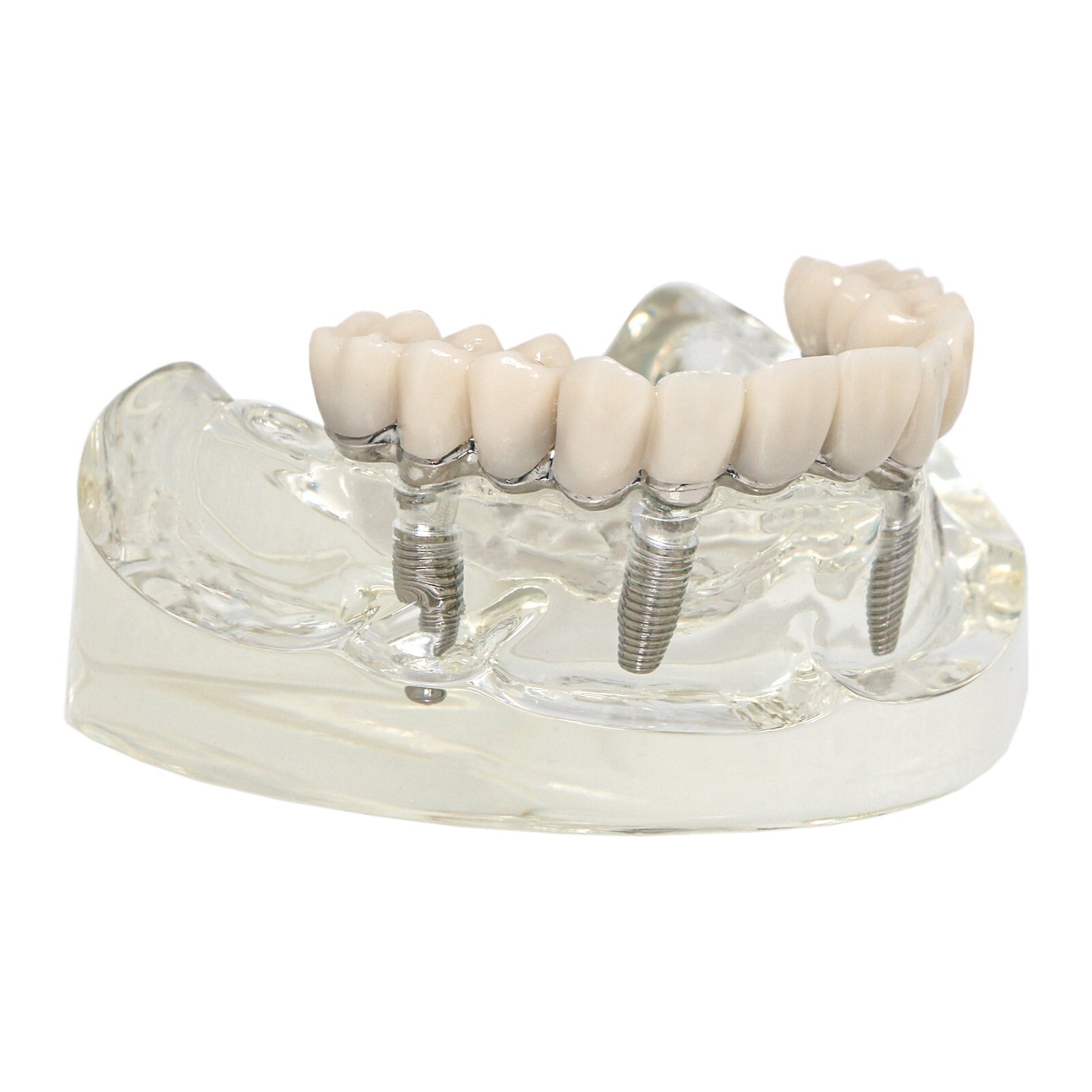 Implants Dental All-on-4 Overdenture Model Upper Jaw Restoration 4 Screws M6023