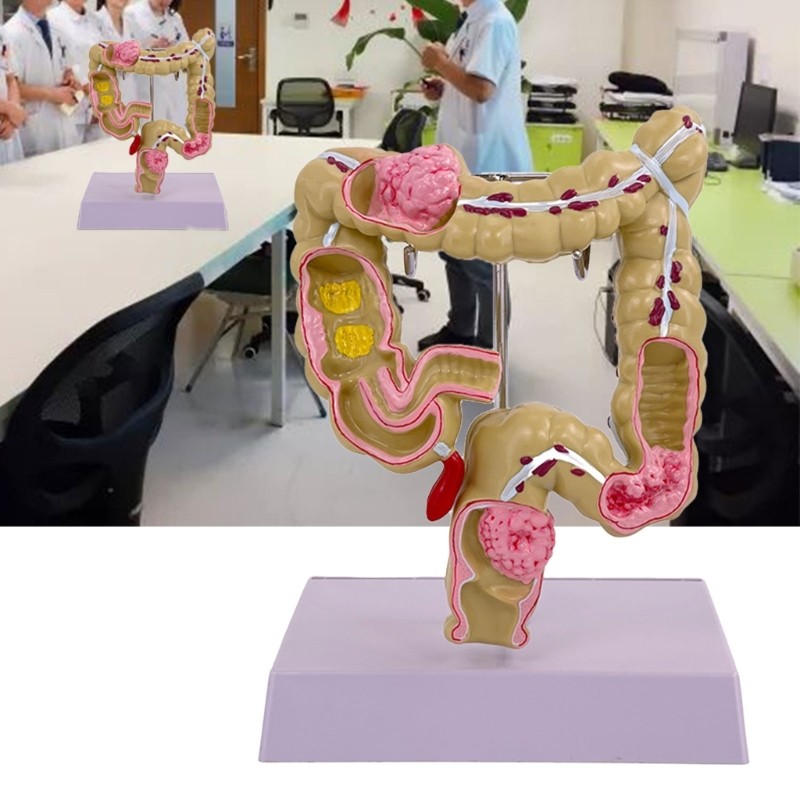 Human Large Intestine Model Teaching Model Medicals Supplies for School Study