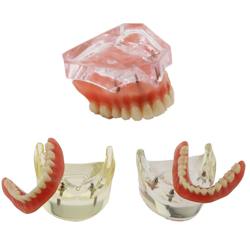 Dental Implant Teeth Model Demo Overdenture Restoration 2/4 Upper/Lower Jaw