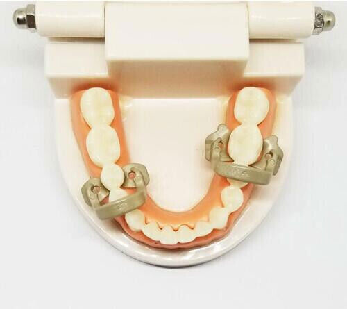 Dental Refill Matrix Plier Narrow Ring Titanium Clamp Niti Fit Palodent Garrison