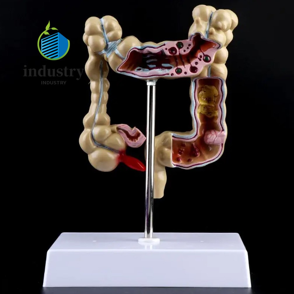 Colorectal Lesion Model Human Colon Large Intestine Pathological Diseases Model
