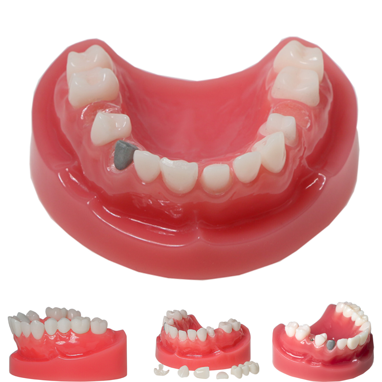 Dental Implant Model PRD Removable Partial Dentures Overdenture treatment Model