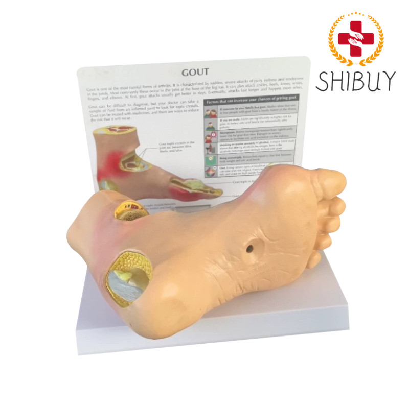 Diabetes Target Organ Model Pain Wind Stone Foot Complication Model