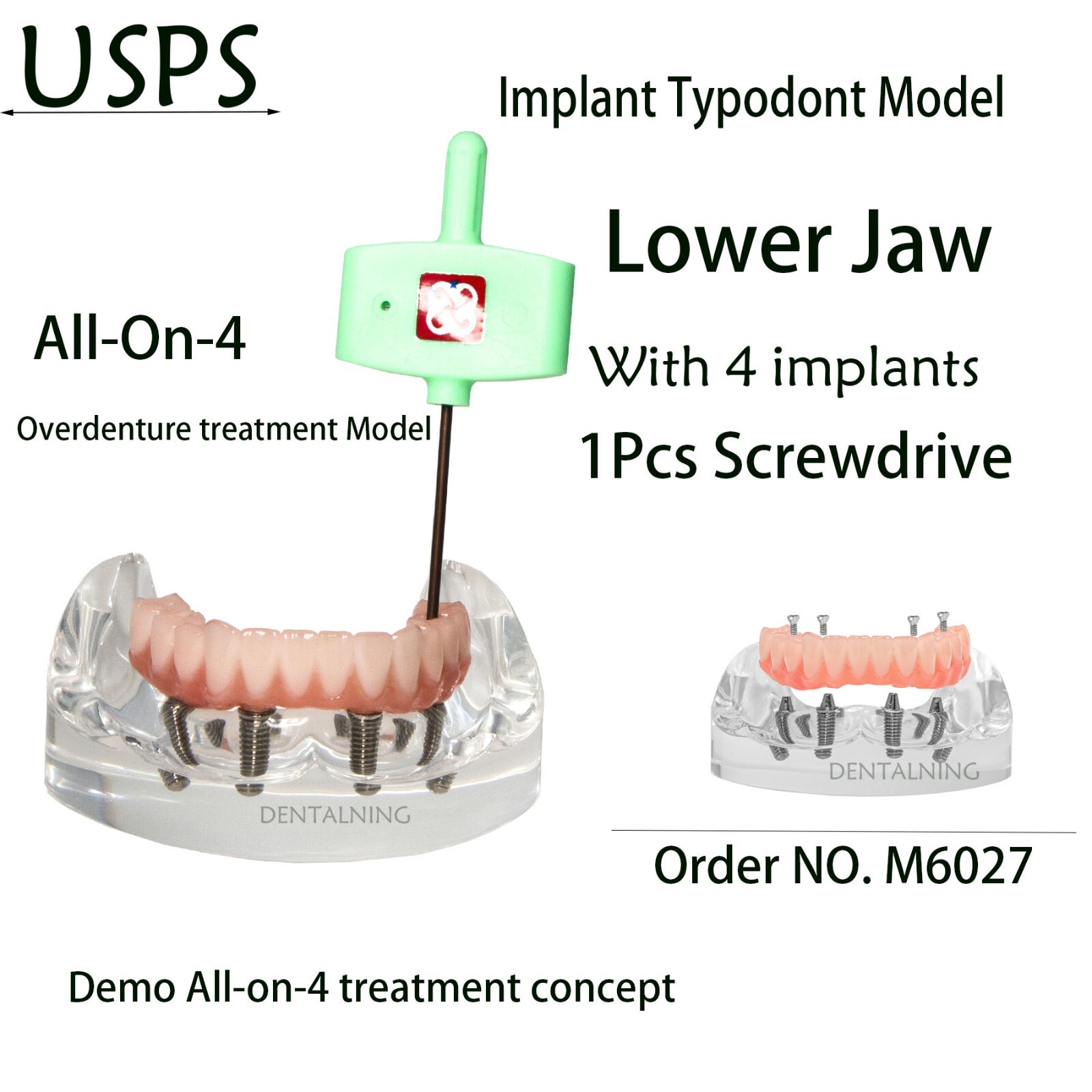 US Dental Implant Model All-on-4 Overdenture treatment Model Lower 4 Implants