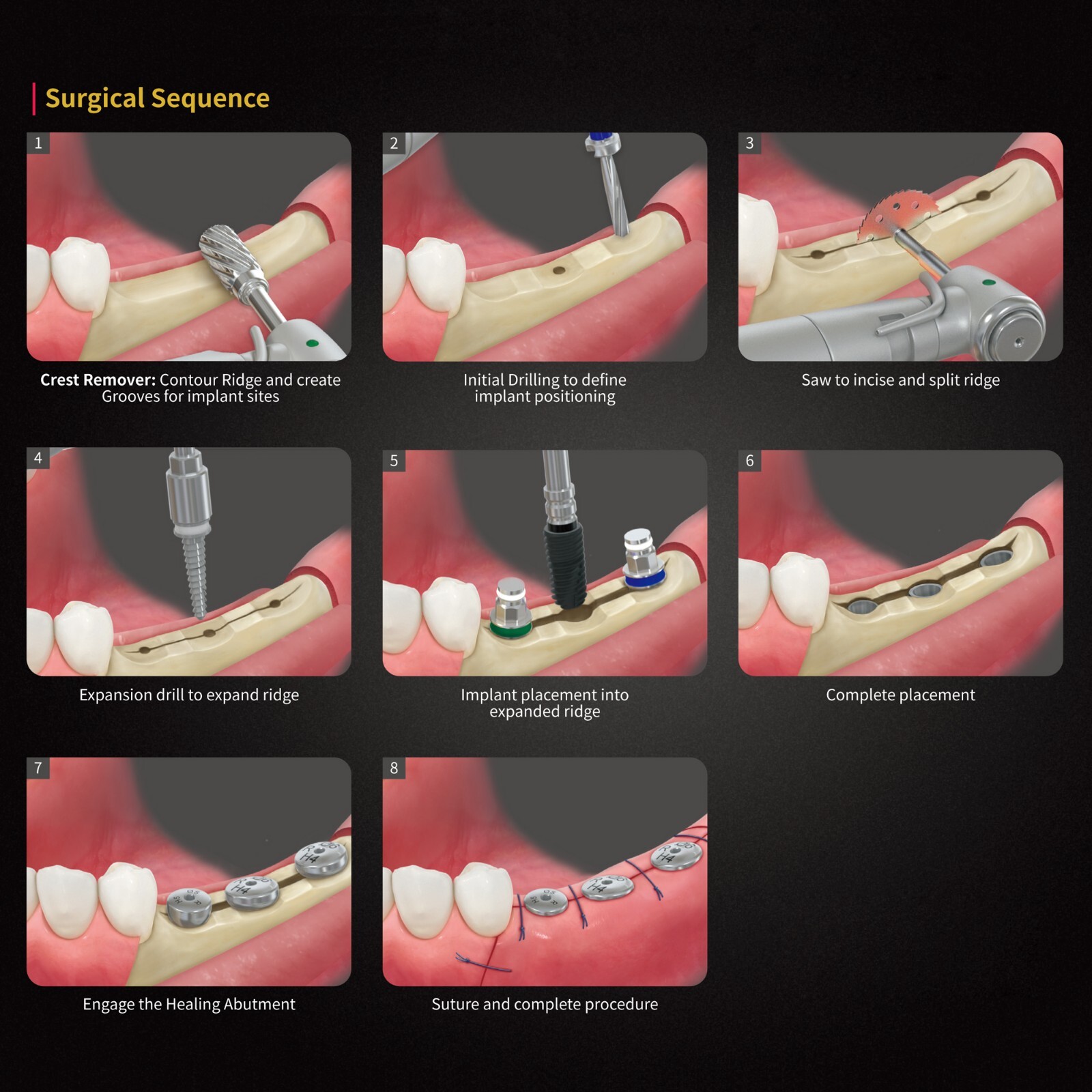 Implant ESSET Kit Easy Split Expansion of the Narrow Ridge HIOSSEN OSSTEM Style