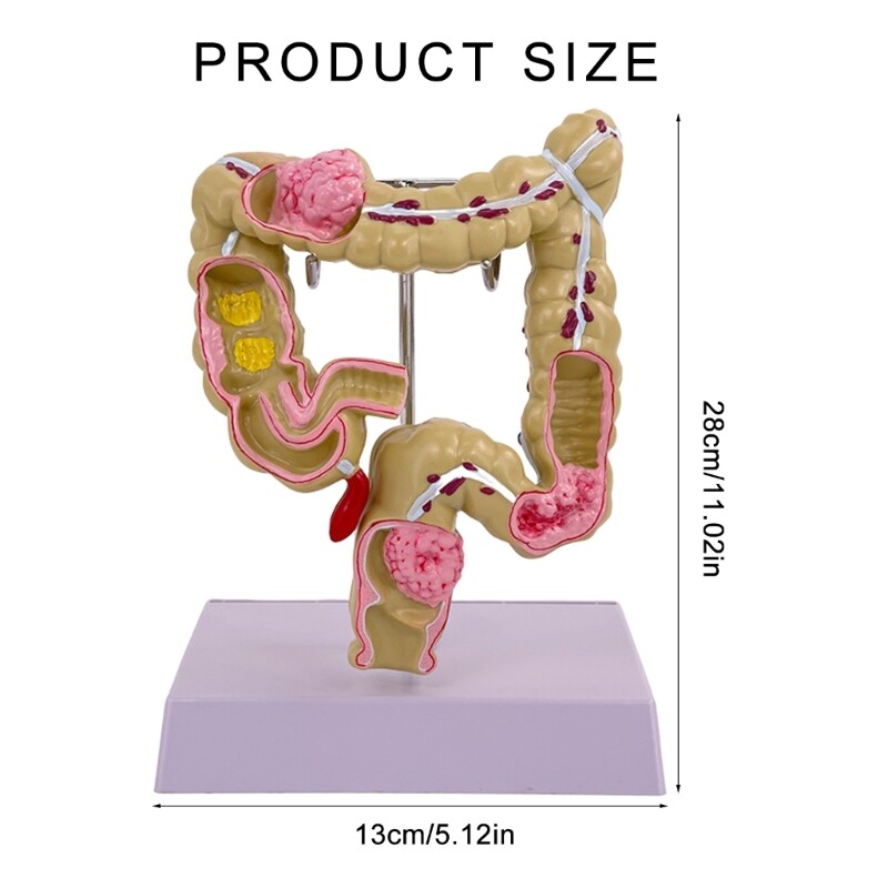 Human Anatomy Model for School Study Human Pathologies of Large Intestine Model