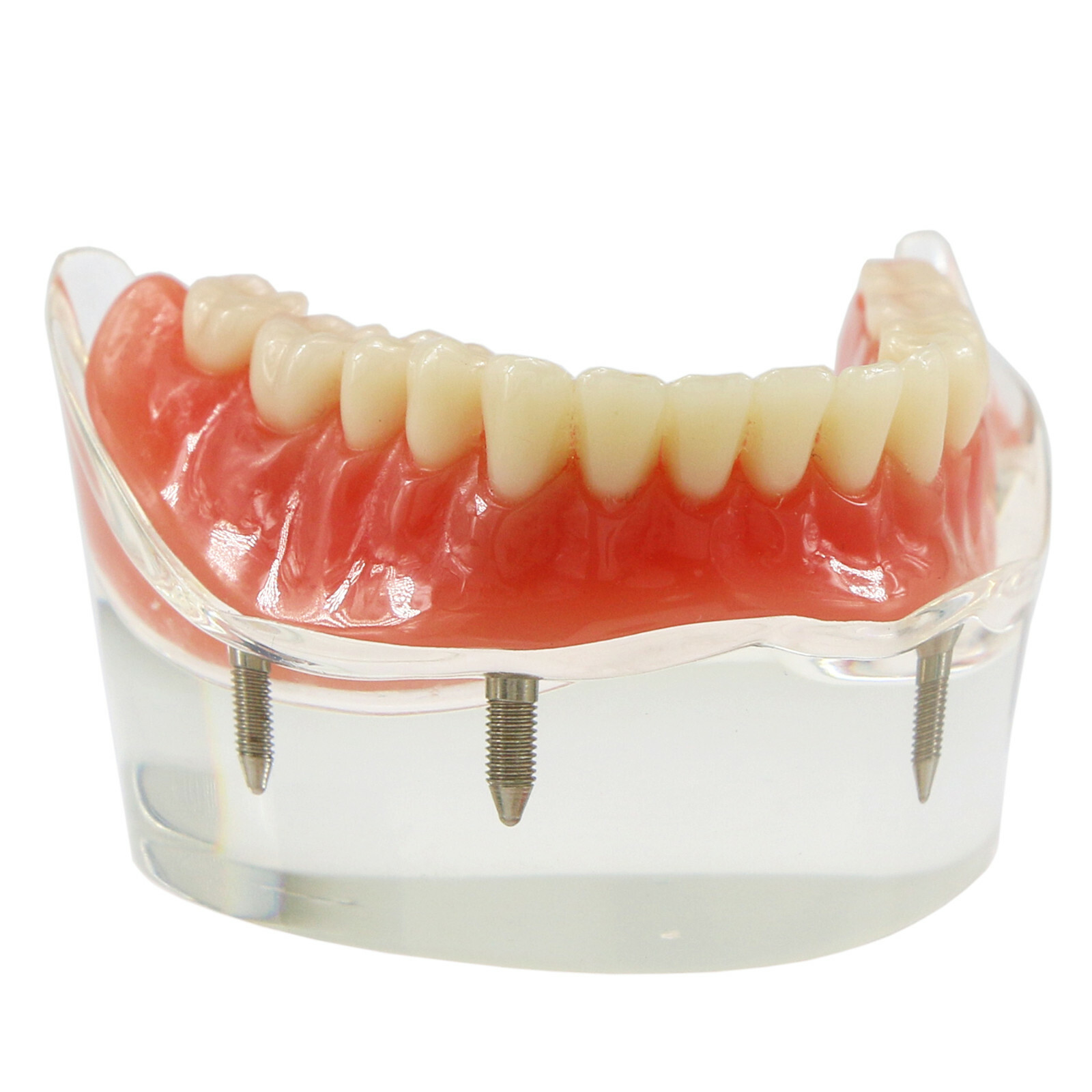 Dental Typodont Teeth Model Overdenture Lower Inferior 4 Implants Demo M6003