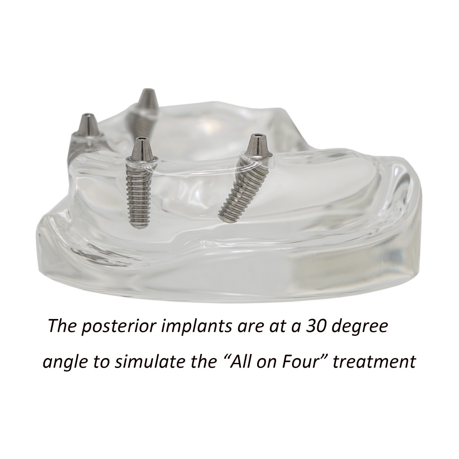 US Dental Implant Teeth Model Overdenture All on 4/All on 6 treatment Demo Model