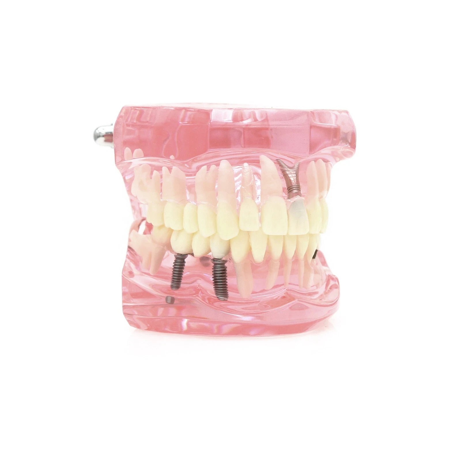 Dental Implant Teeth Model Teach Study Demo Restoration Pathology #2001 Pink