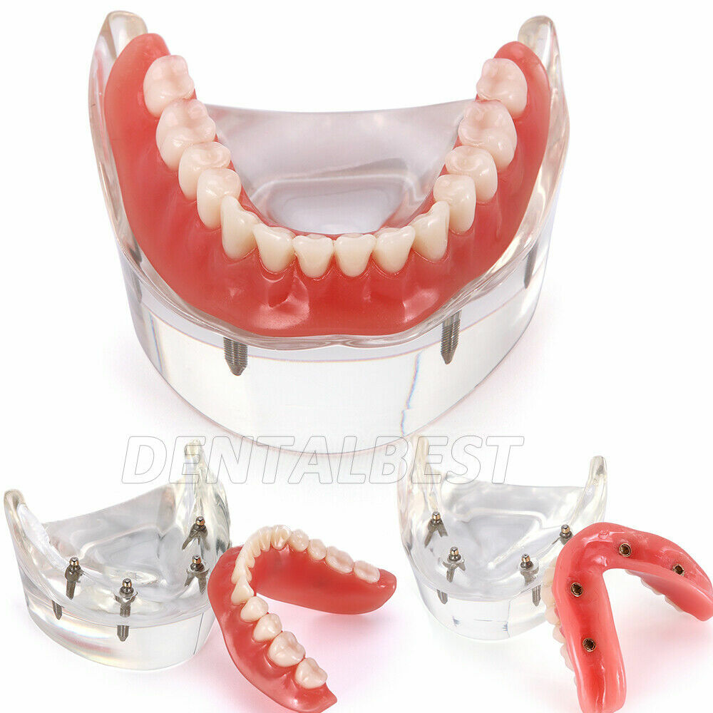 Dental Demonstration 4 Implants Teeth Model Typodont Inferior Overdenture Lower
