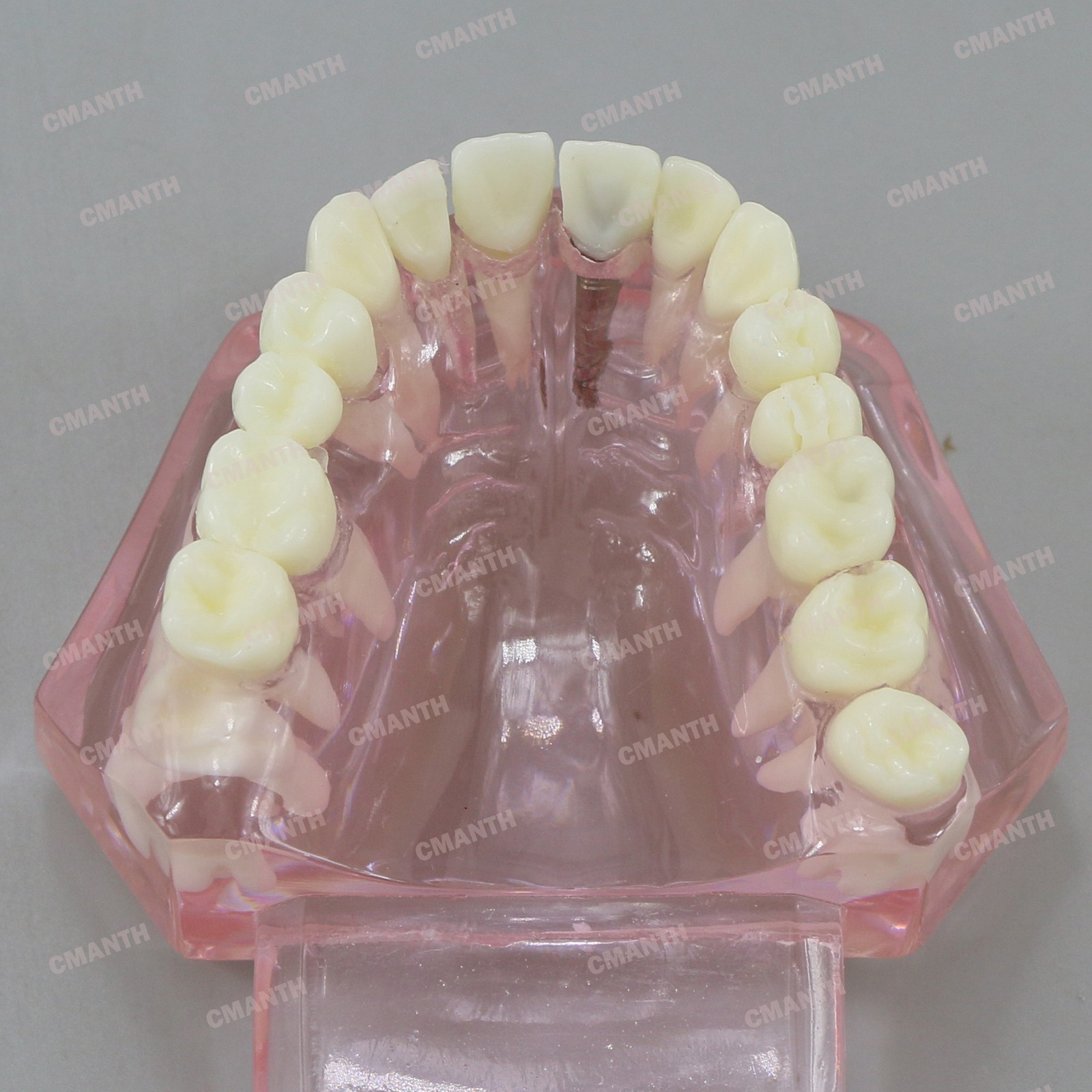 Dental Teeth Model Ortho Implant Practice Teaching of Implants Demo Model