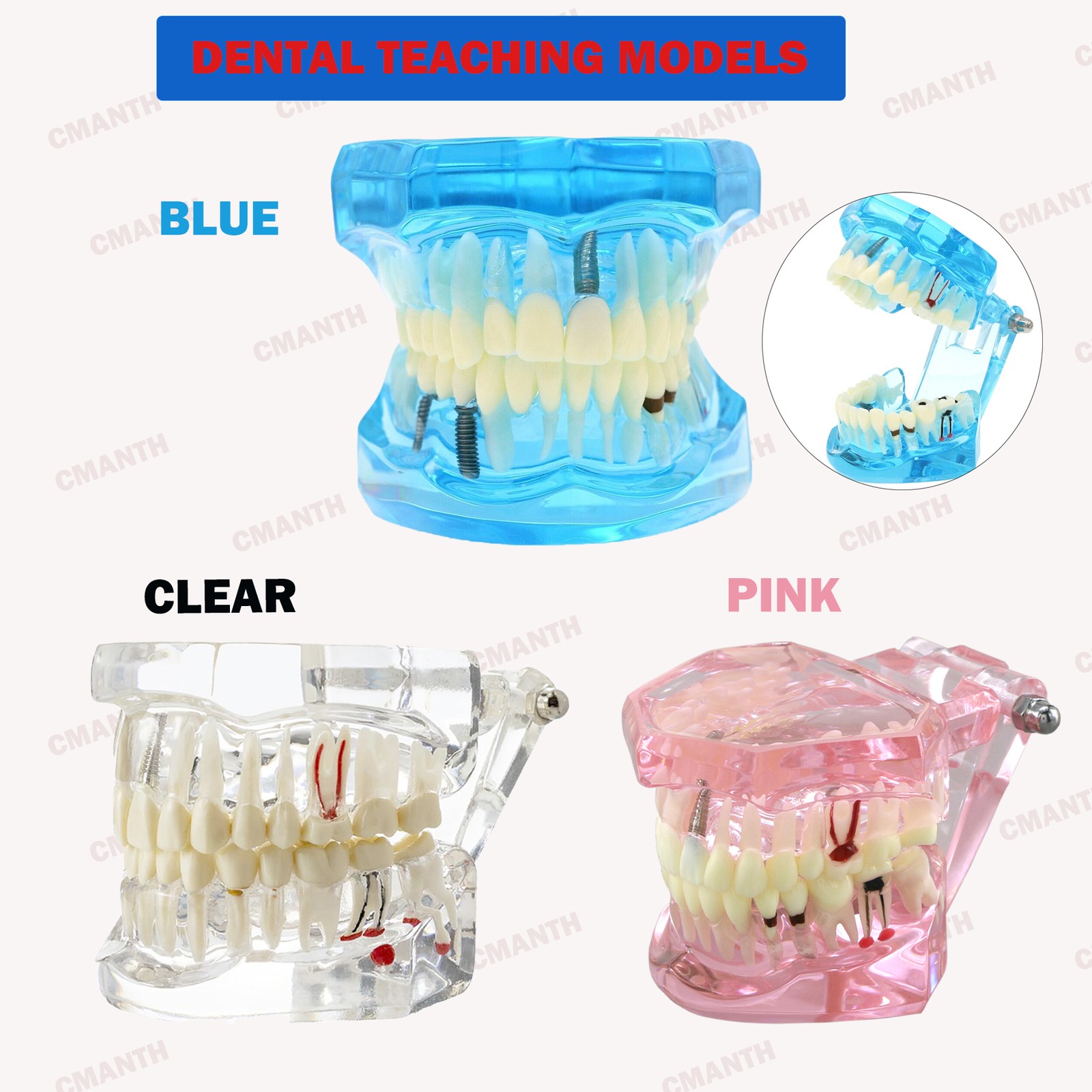 Dental Teeth Model Ortho Implant Practice Teaching of Implants Demo Model