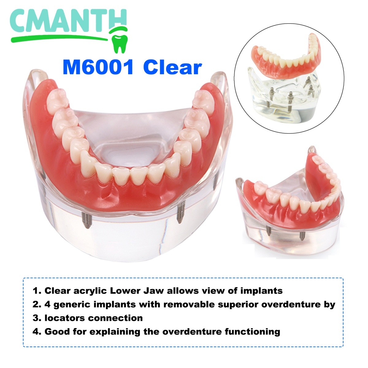 Dental Implant Teeth Model 4 Implants Upper/Lower Overdenture Restoration Model