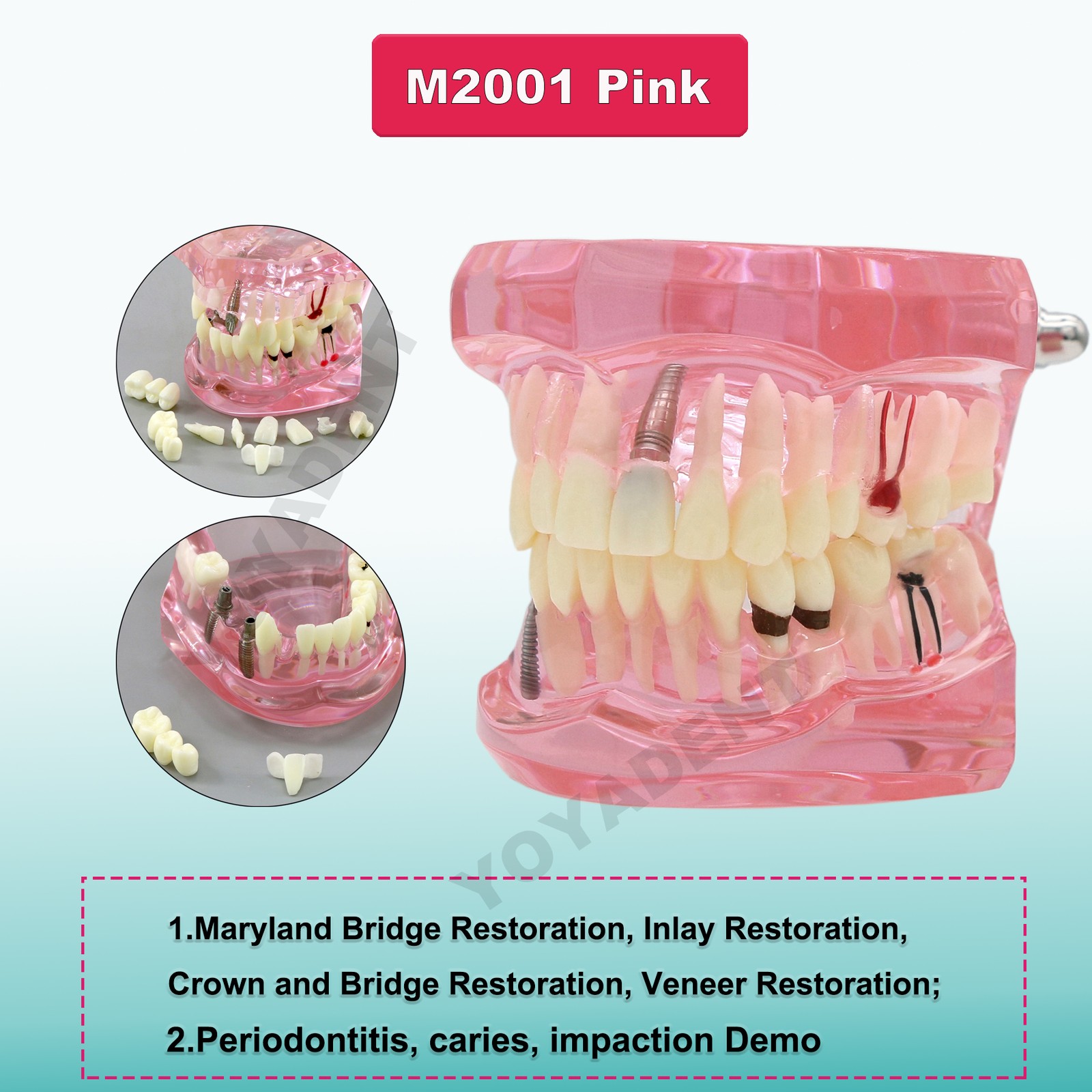 Dental Teeth Model Upper Lower Jaw 4 Overdenture Practice Implant Typodont Demo