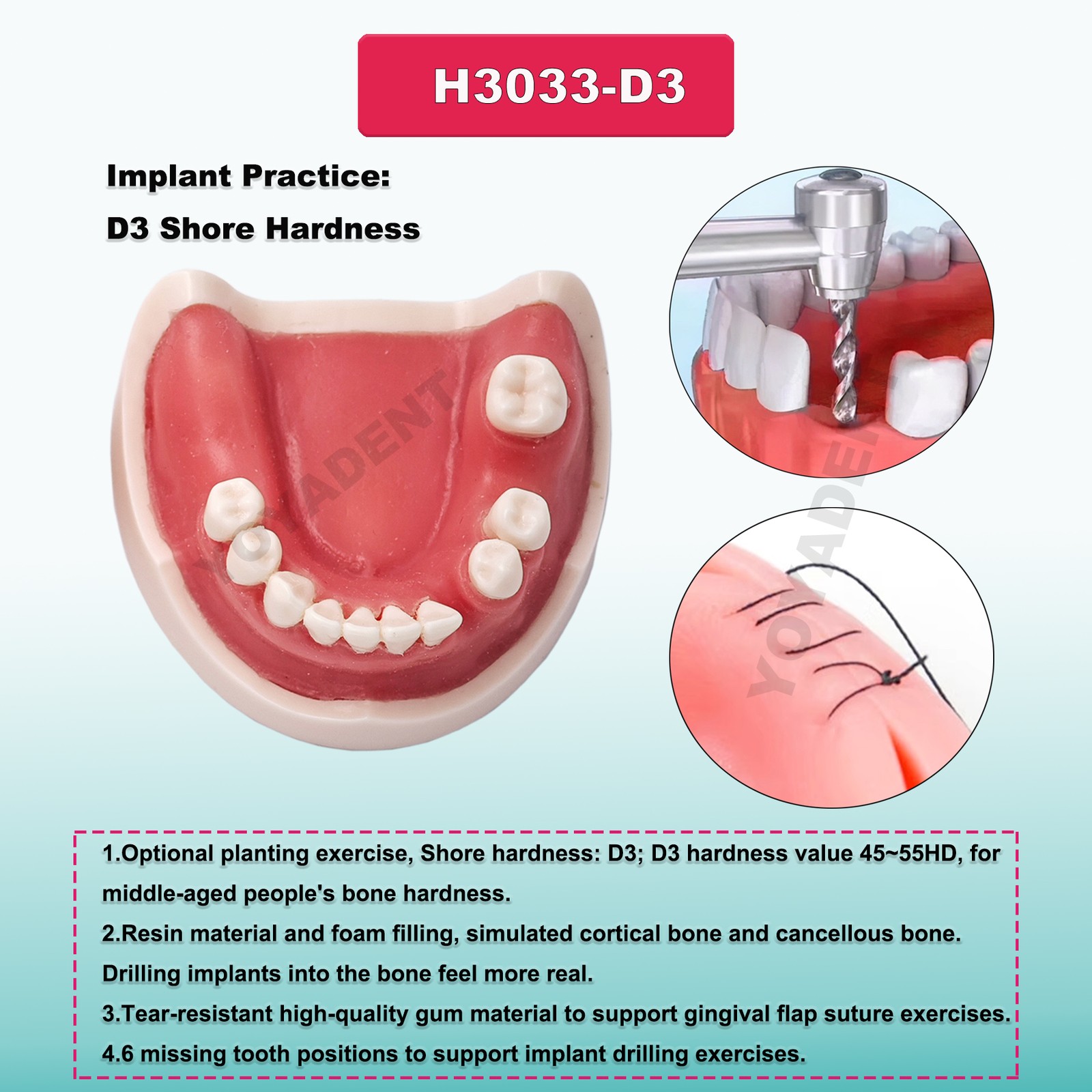 Dental Teeth Model Upper Lower Jaw 4 Overdenture Practice Implant Typodont Demo