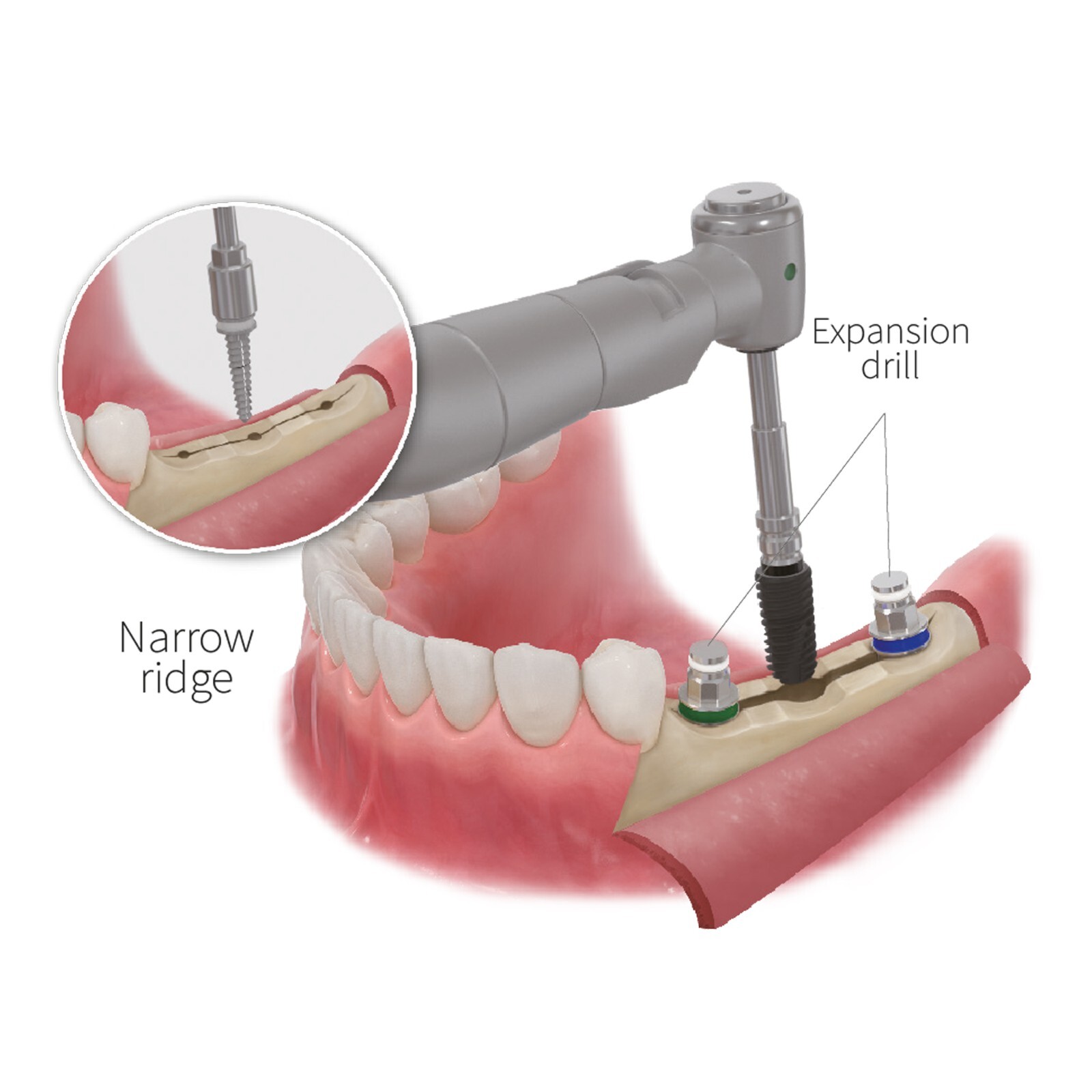 HIOSSEN OSSTEM Style Implant ESSET Kit Easy Split Expansion of the Narrow Ridge